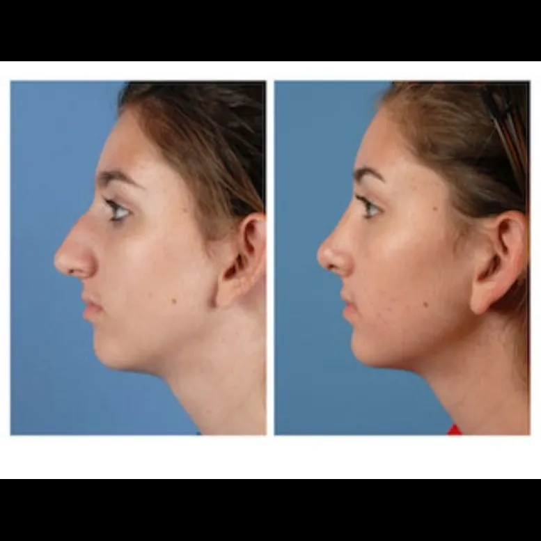 Nose Reshaping in Delhi
Looking to refine your no...