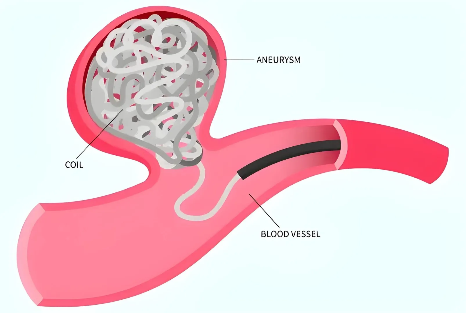 Aneurysm Treatment in Pune – Preventive Surgical C...