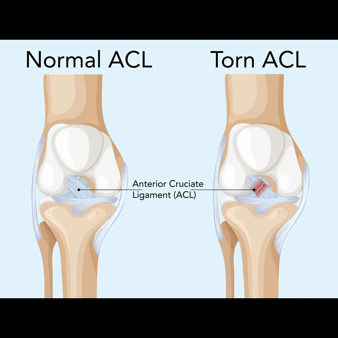 ACL Reconstruction Surgeon in Nagpur – Restore Kne...