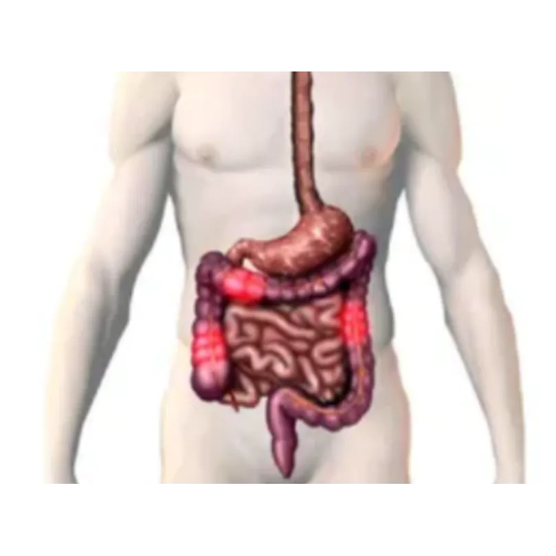 Ustekinumab: A New Option for IBD Patients in Mumb...