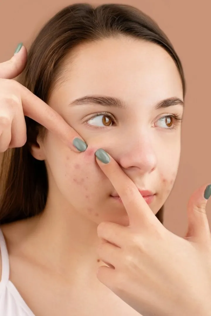 ✨ Say Goodbye to Acne with the Best Treatment in D...