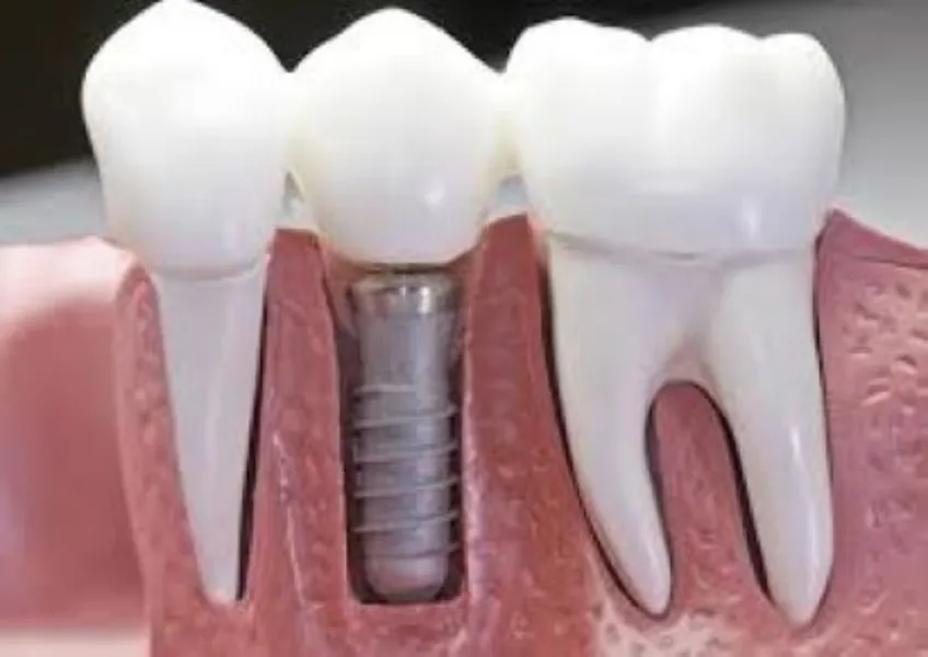Cosmetic Dentistry Treatment in Dhule – Smile Make...