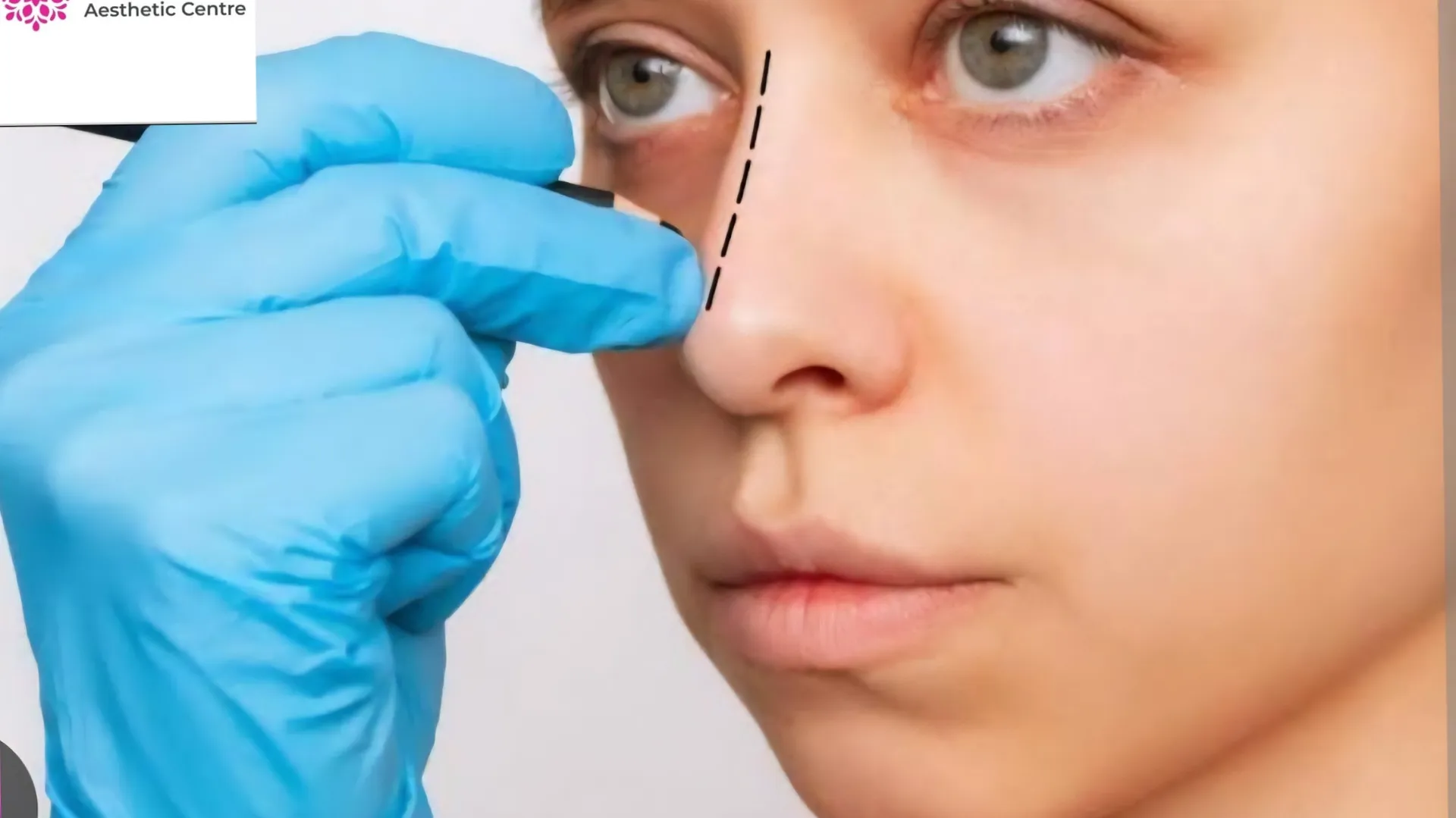 Who is the Best Rhinoplasty Surgeon in Delhi? Disc...