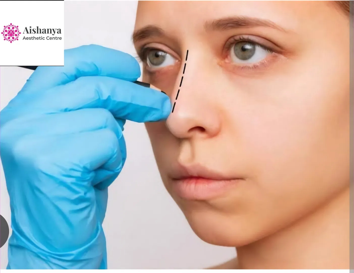 ✨ Minimal Scar Rhinoplasty Surgery in Dwarka @Aish...
