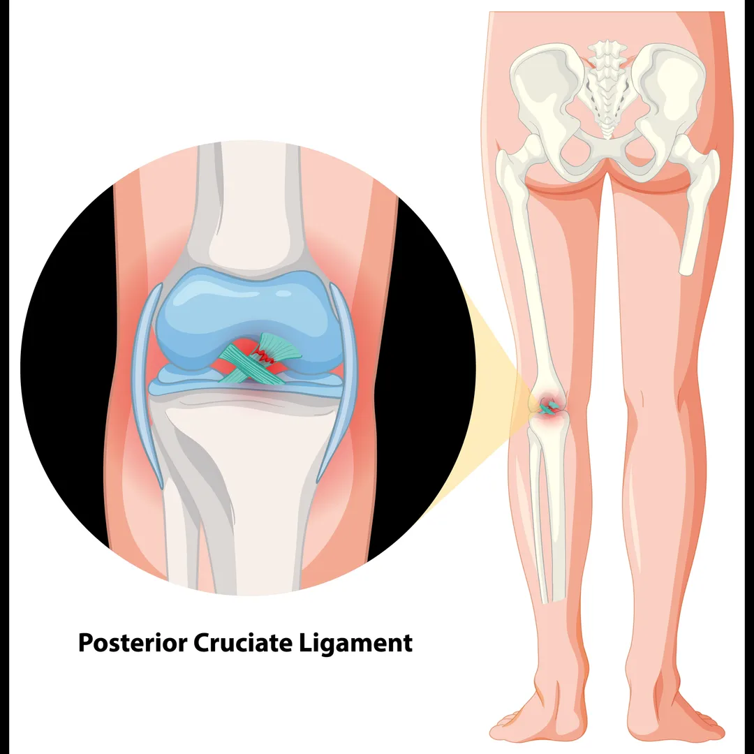 Multi-Ligament Knee Reconstruction in Bangalore – ...