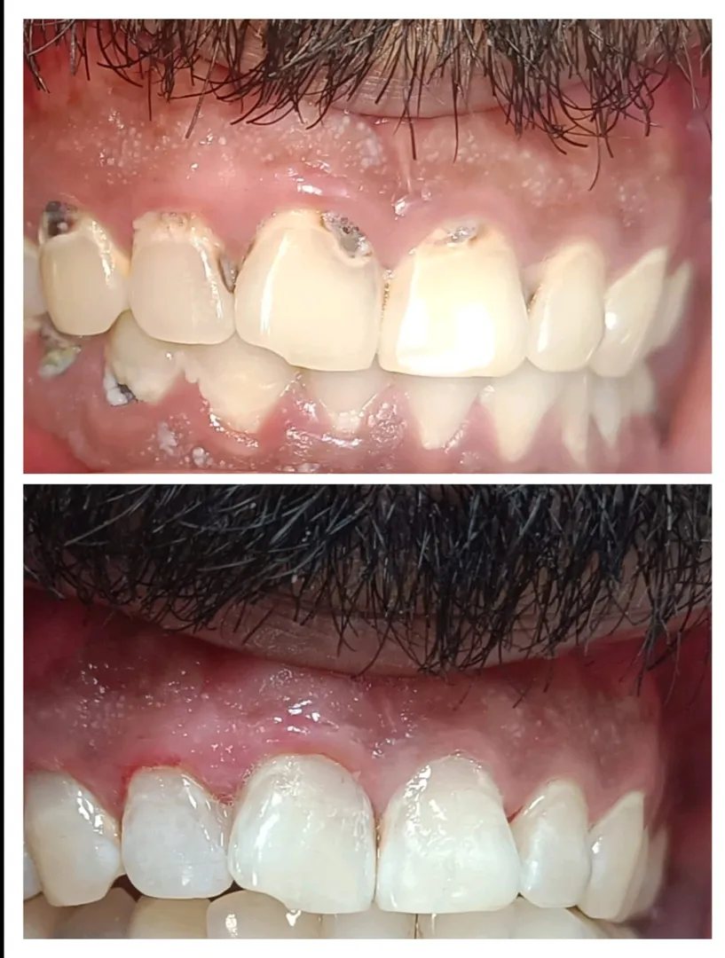 Aesthetic Filling for Front Teeth with Composite R...
