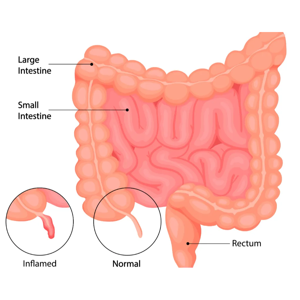 Appendix Surgery in Kolathur, Chennai – Immediate ...