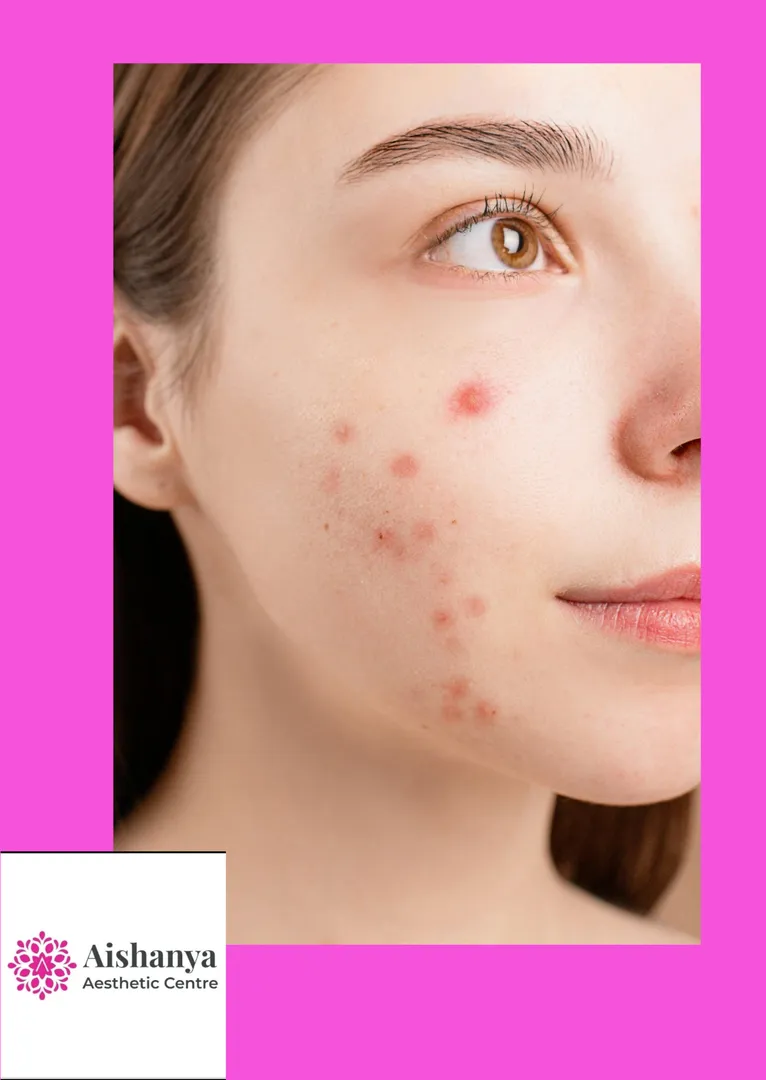 Best Clinic for Acne Scar Microneedling – Aishanya...