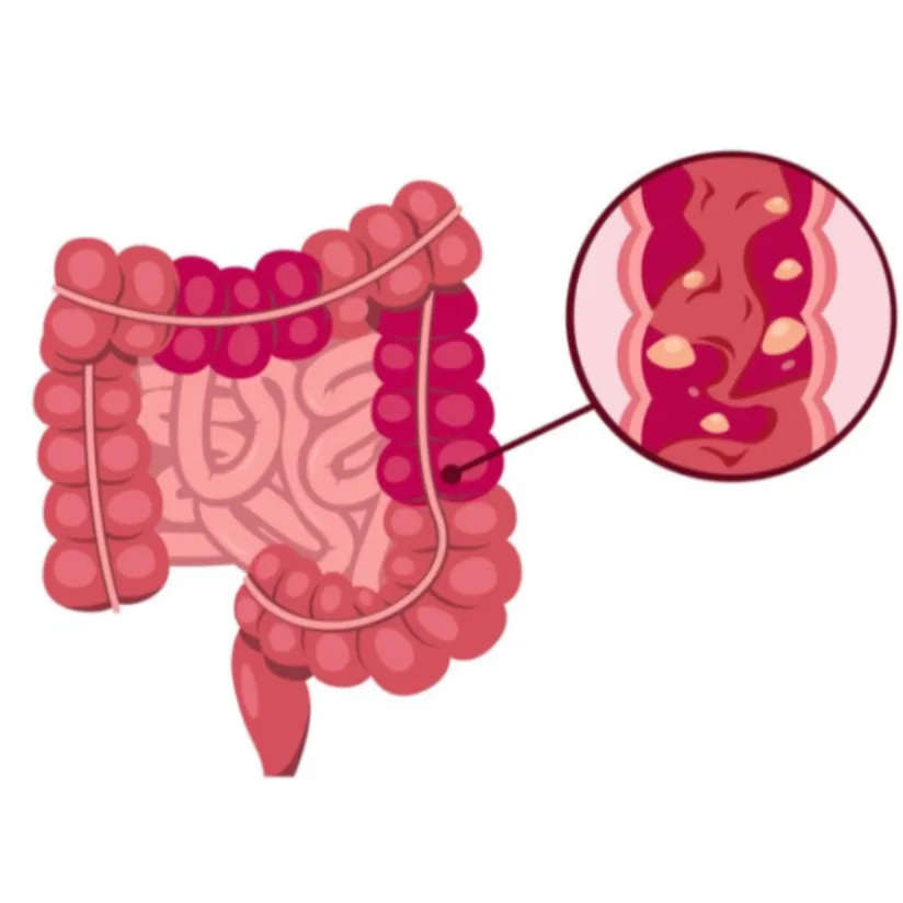 Inflammatory Bowel Disease (IBD) in Mumbai Inflamm...