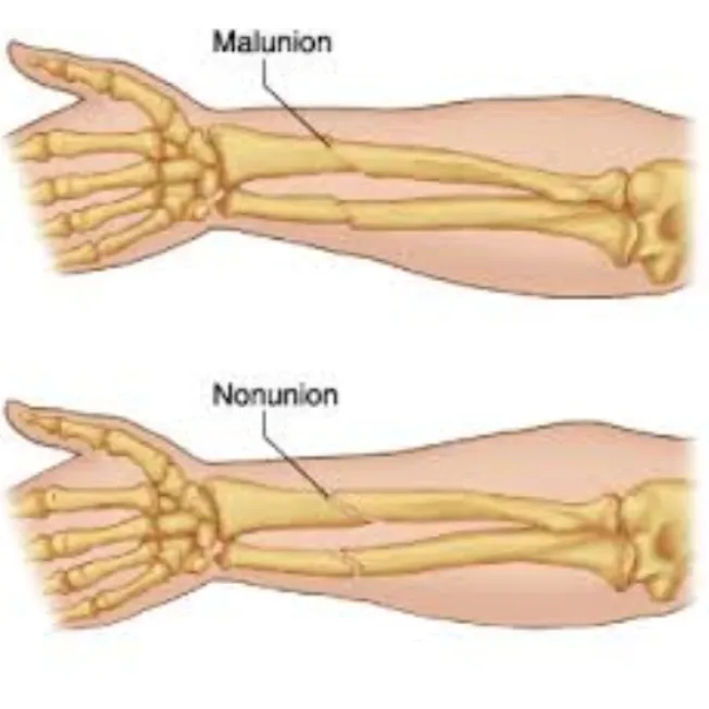 Nonunion Malunion Treatment in Pimpri Chinchwad – ...