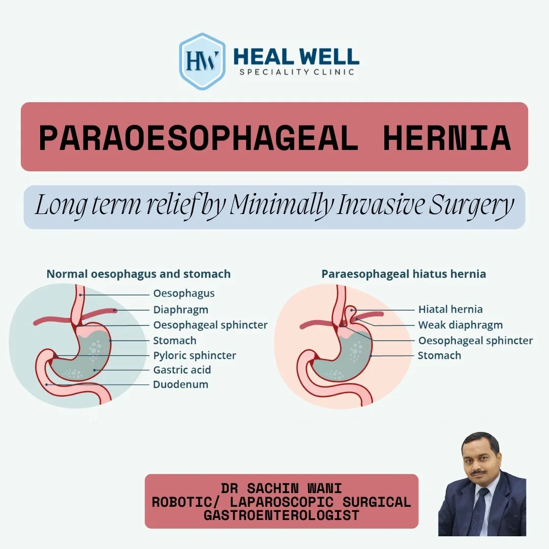 Paraoesophageal Hernia Treatment in Thane – Expert...
