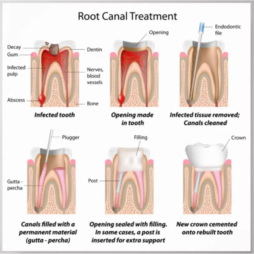 Root Canal Therapy in Hyderabad – Relief Without the My...