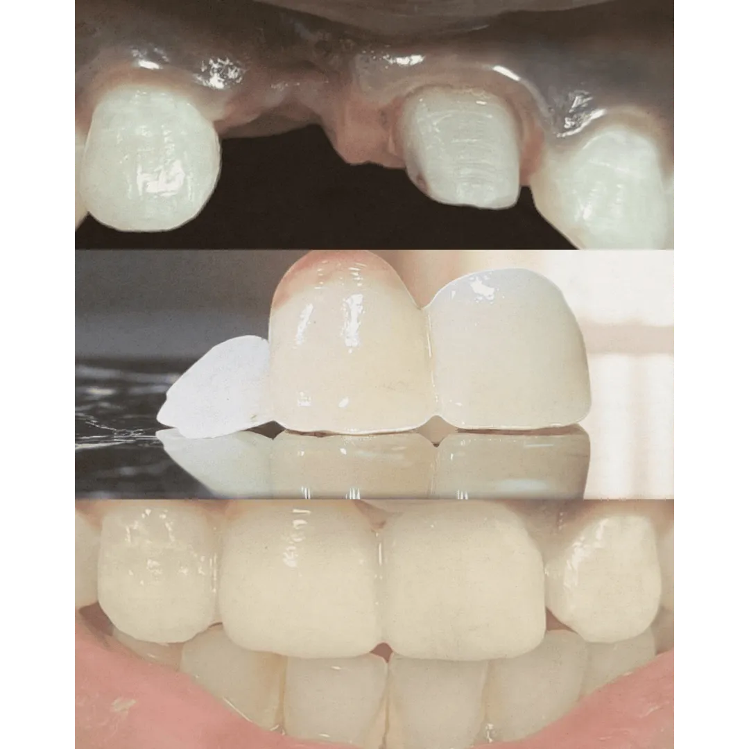 Smile Transformation with Zirconia Crowns & Bridges at Procare Dental Clinic, Th...