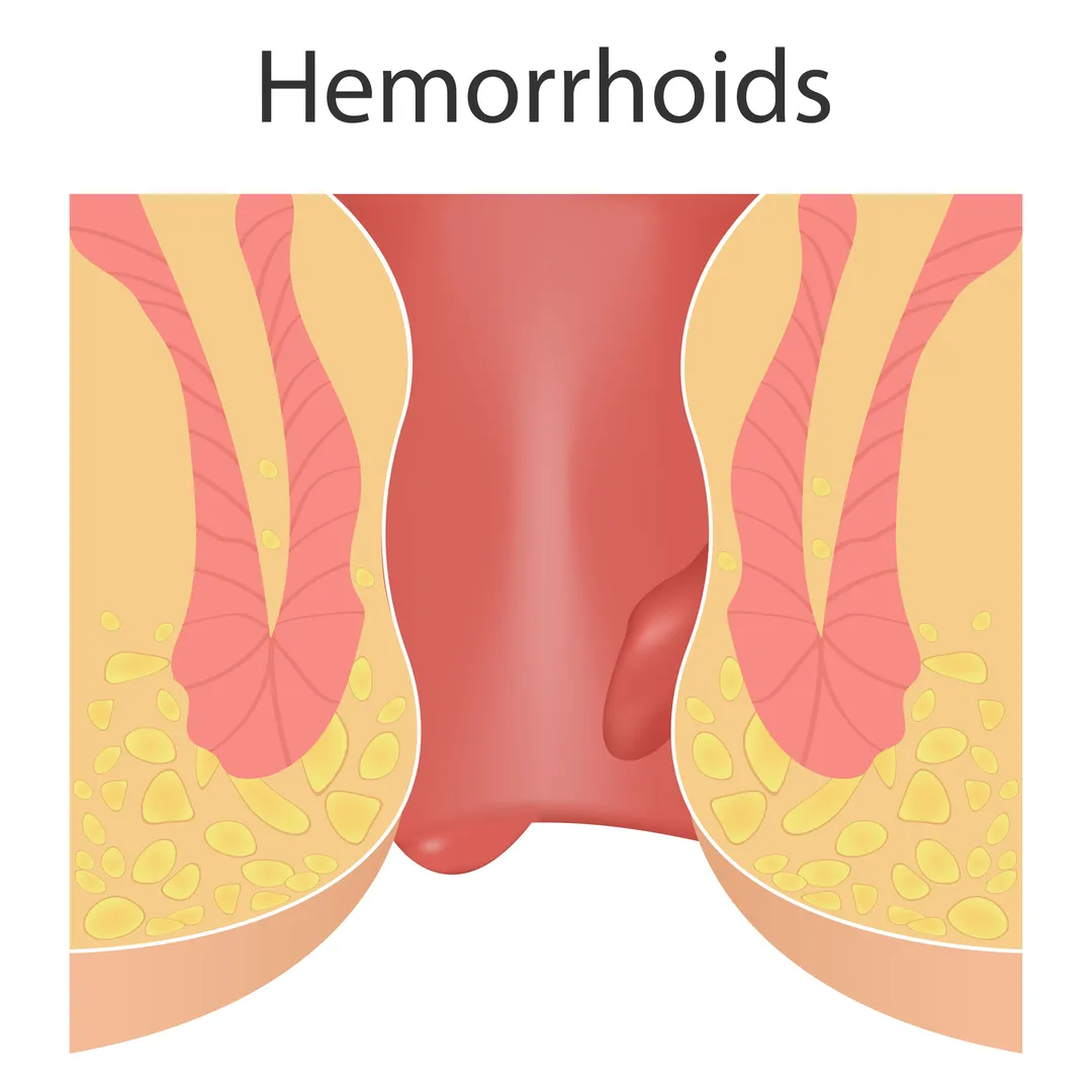 Hemorrhoid Specialist in Byculla – Get Expert Relief Without De...