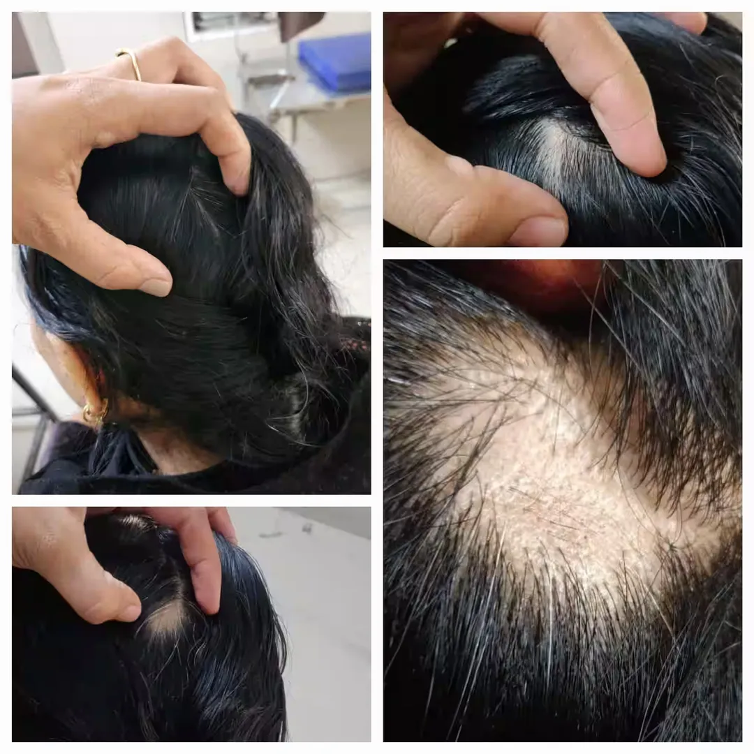 Best Alopecia Areata Treatment in Dhule – Gindodia Hospi...