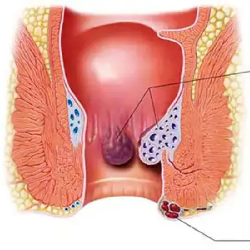 Piles Treatment Doctor in Chembur – Say Goodbye to Discomf...