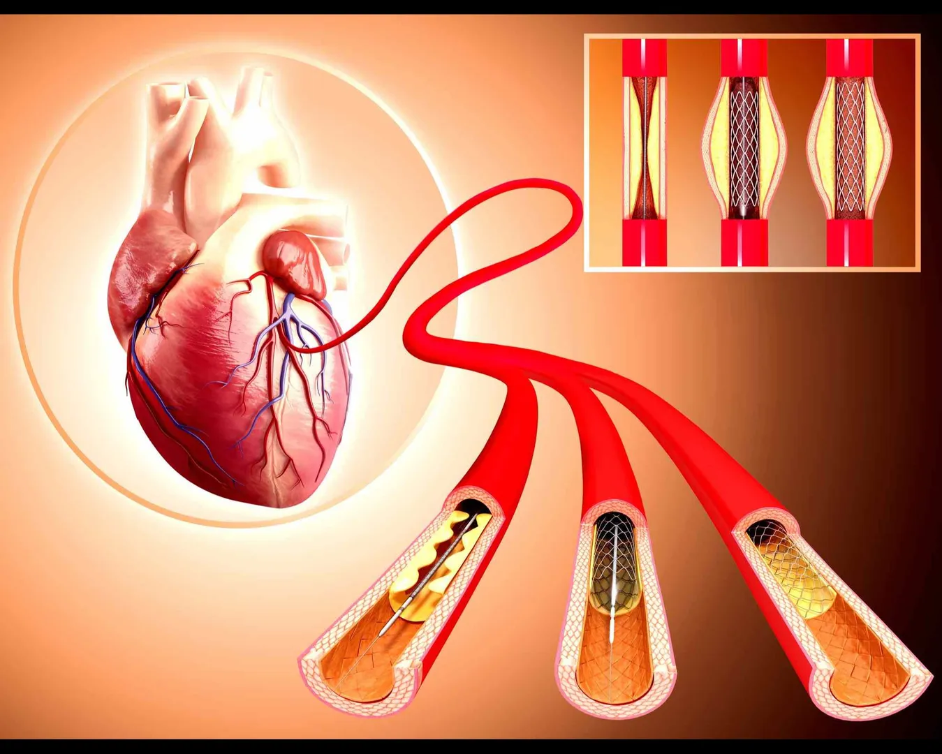 Angioplasty in Pune – Restore Blood Flow with Precision C...