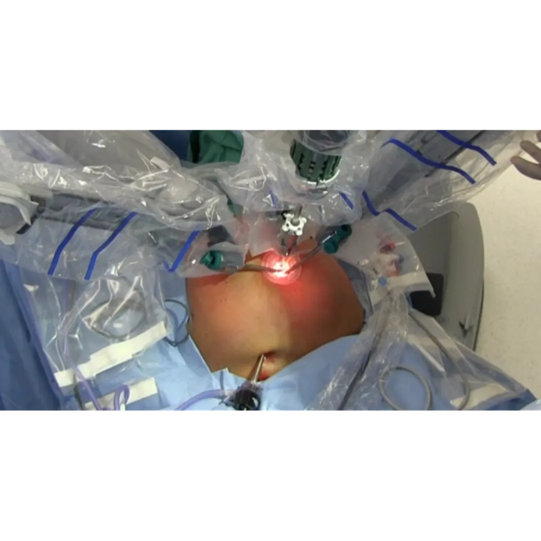 Advanced Robotic Gallbladder Surgery Near Dasarahalli – Gentle and Precise C...