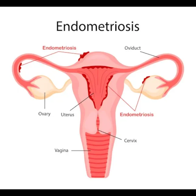 Endometriosis Treatment in Thane – Relief from Chronic Pelvic PainExperiencing painful periods, fati...