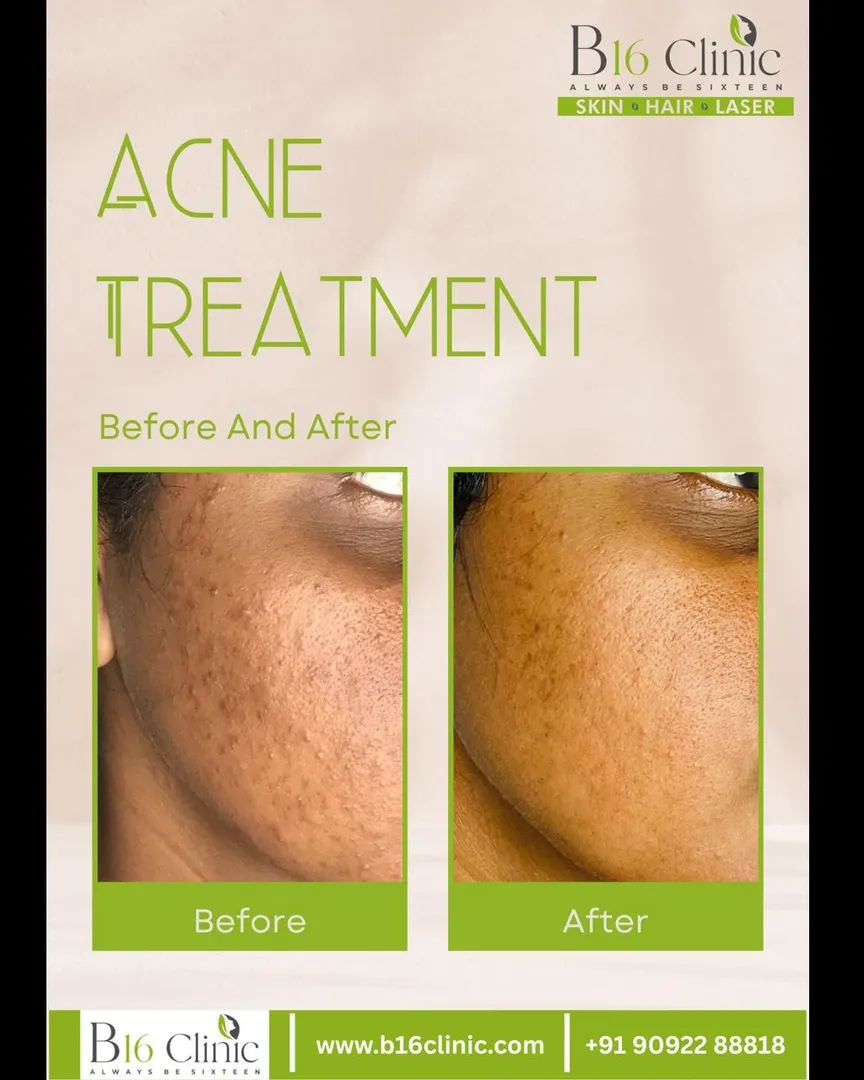 Best acne scar treatment in coimbatore