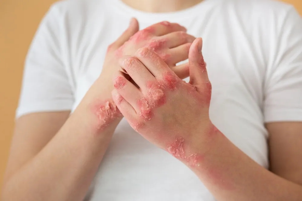 Psoriasis Treatment in Brahmand – Calm the Flare-Ups, Regain Cont...