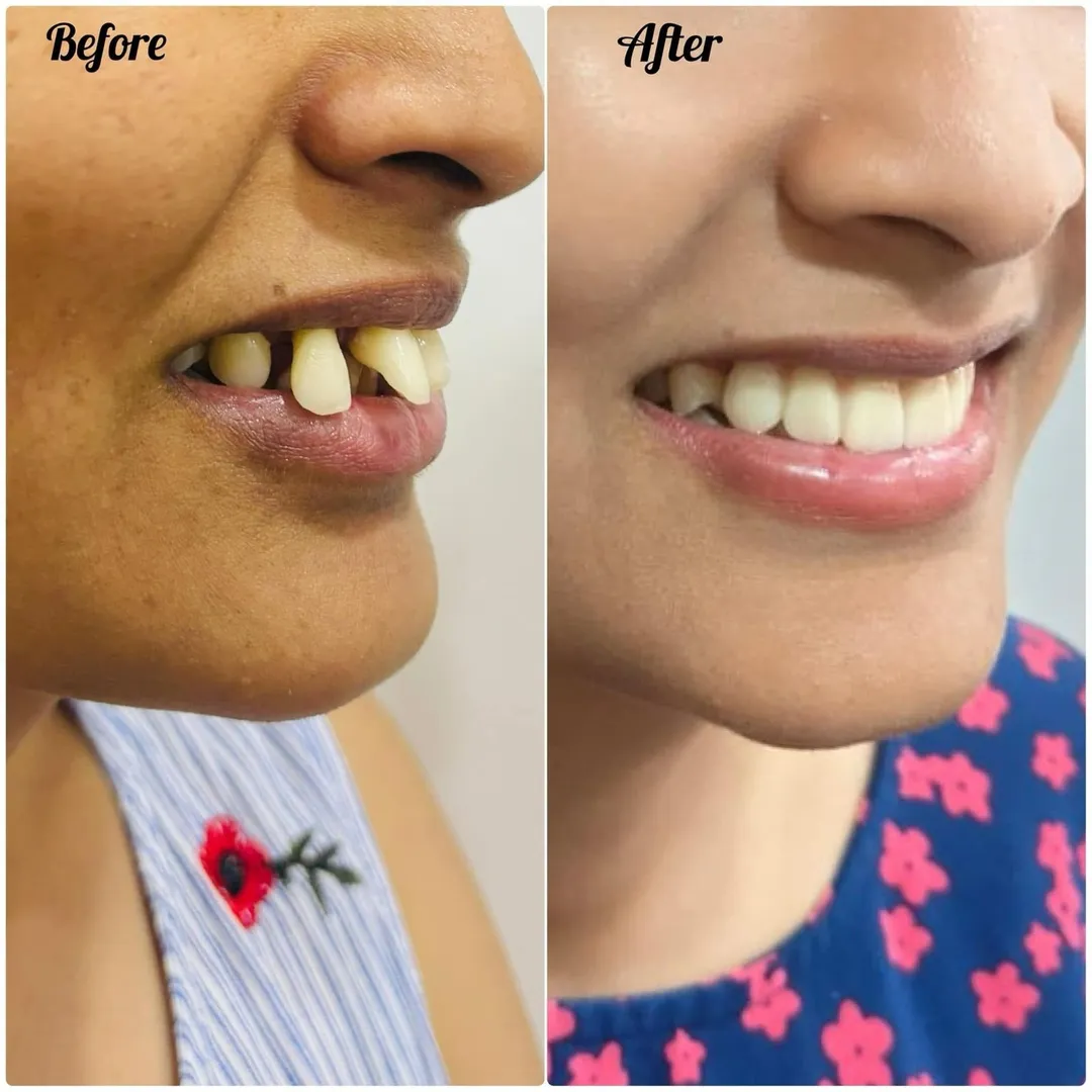 Dental Implants