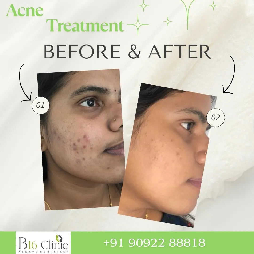 Acne Treatment in Coimbatore