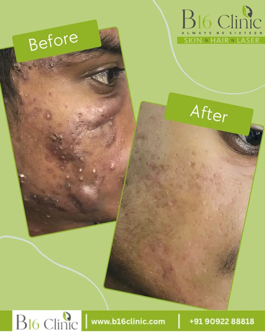 Best Doctors for Acne Treatment in Coimbatore – B16 Cli...