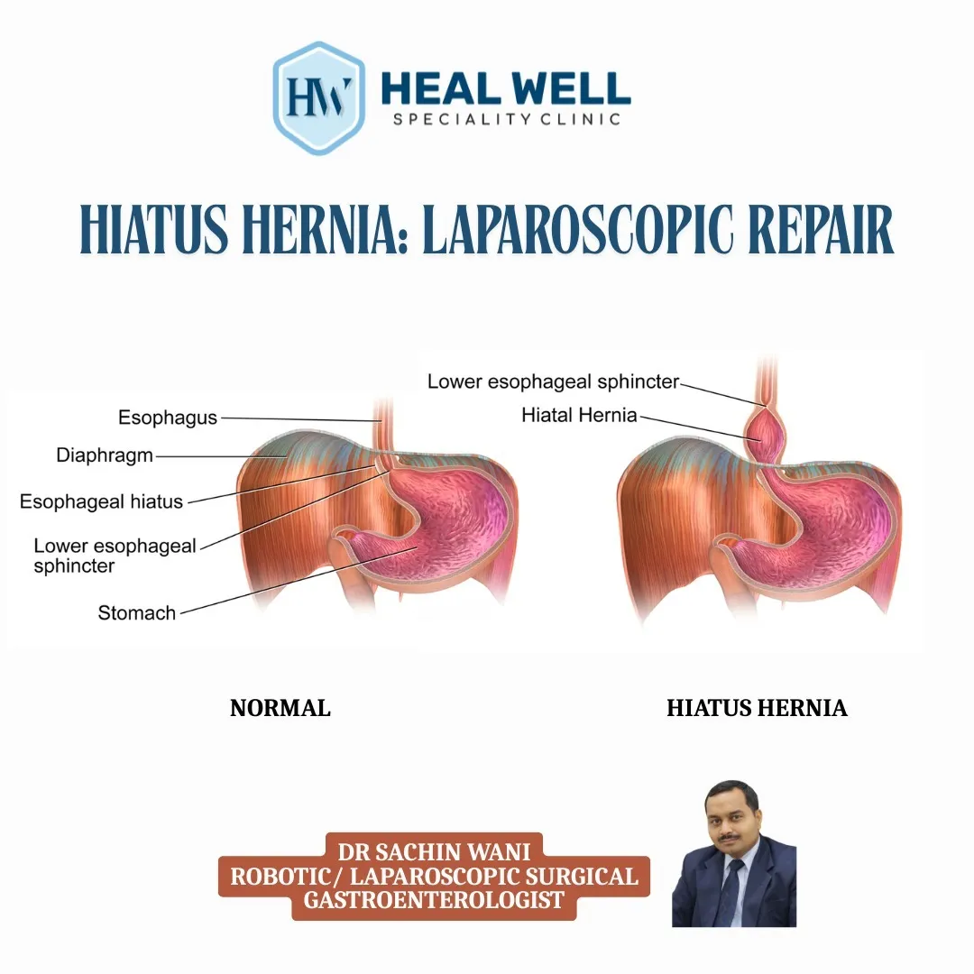 Laparoscopic Surgery for Hiatus Hernia in Thane