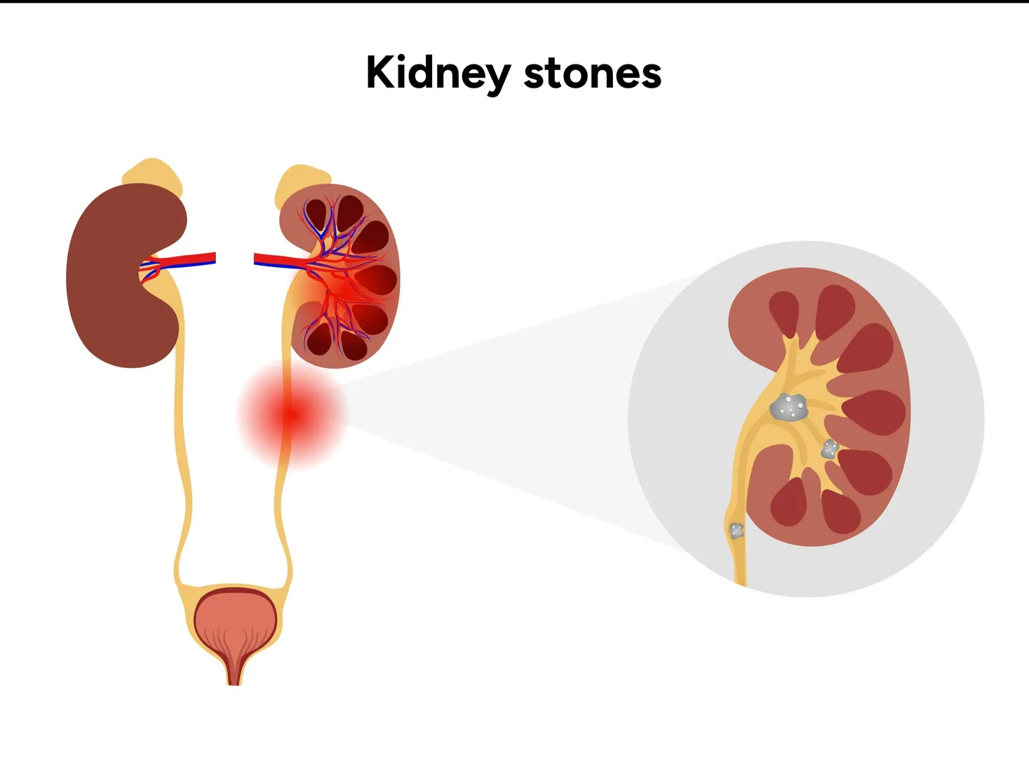 Kidney Stone Surgeon in Thane – Precision Treatment That Brings Real Rel...