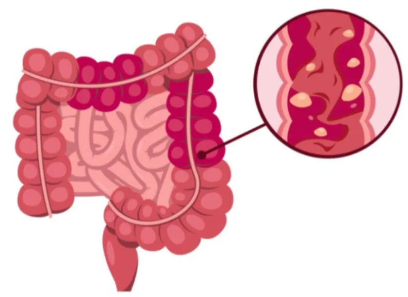 Ulcerative Colitis Specialist in Mumbai