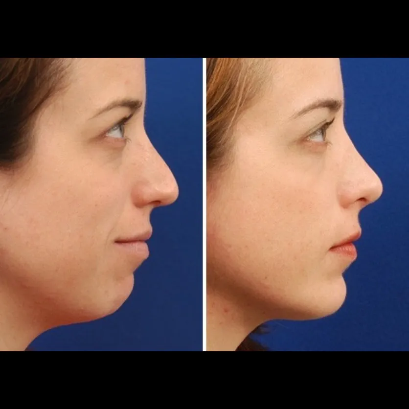 Nose Reshaping in Delhi
