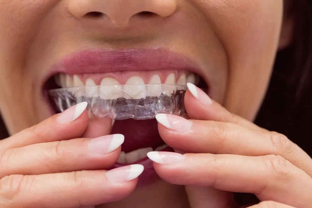Invisalign Aligners in Hyderabad – The Clear Way to a Confident Sm...