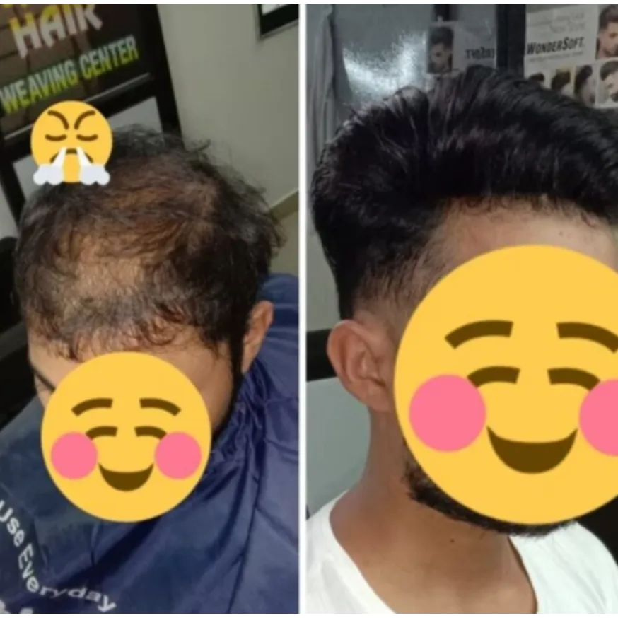 USA Technique Hair Weaving in Nagpur – Advanced Hair Restorat...