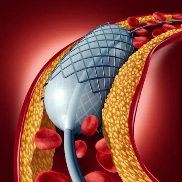 Interventional Cardiology in Aundh – Advanced Treatment for Complex Heart Iss...