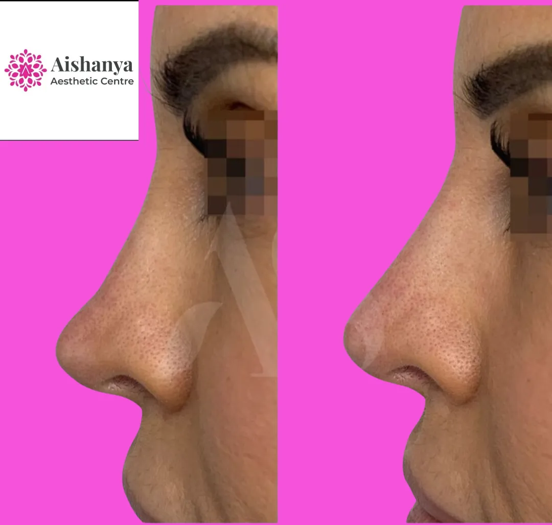 Best Rhinoplasty Surgeon in Delhi-NCR, Janakpuri, Dwa...