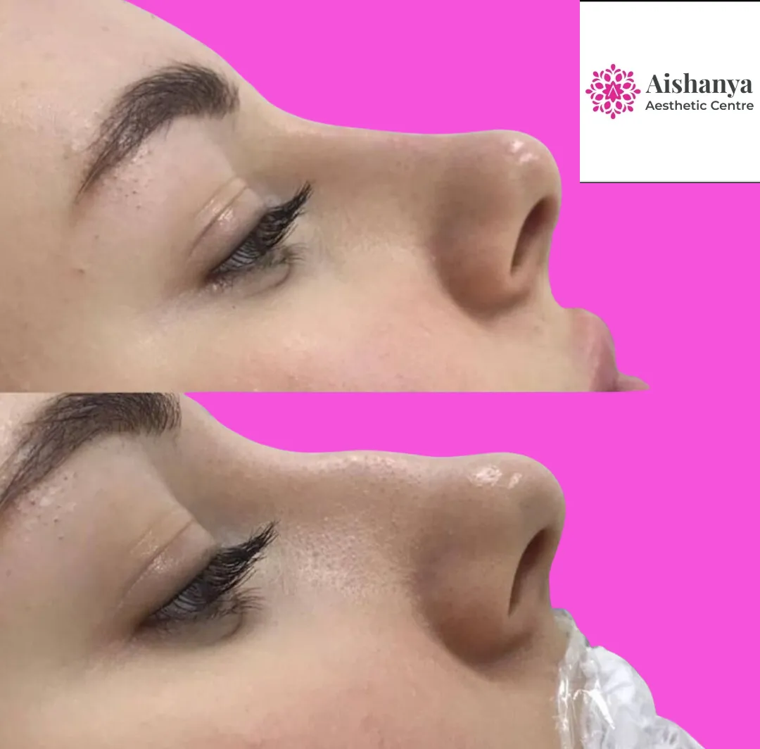 How to Choose best Rhinoplasty surgeon?