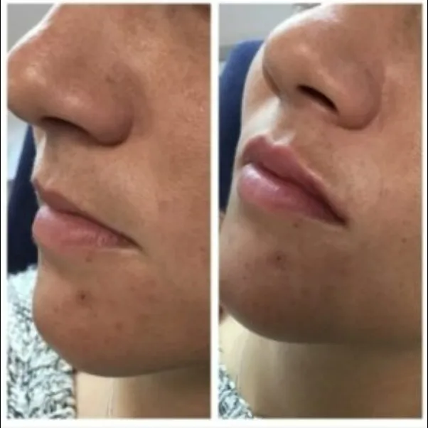 DERMAL FILLERS
✨ Restore. Revive. Rejuvenate. ✨
Say goodbye to wrinkles and hello to youthful, glo...