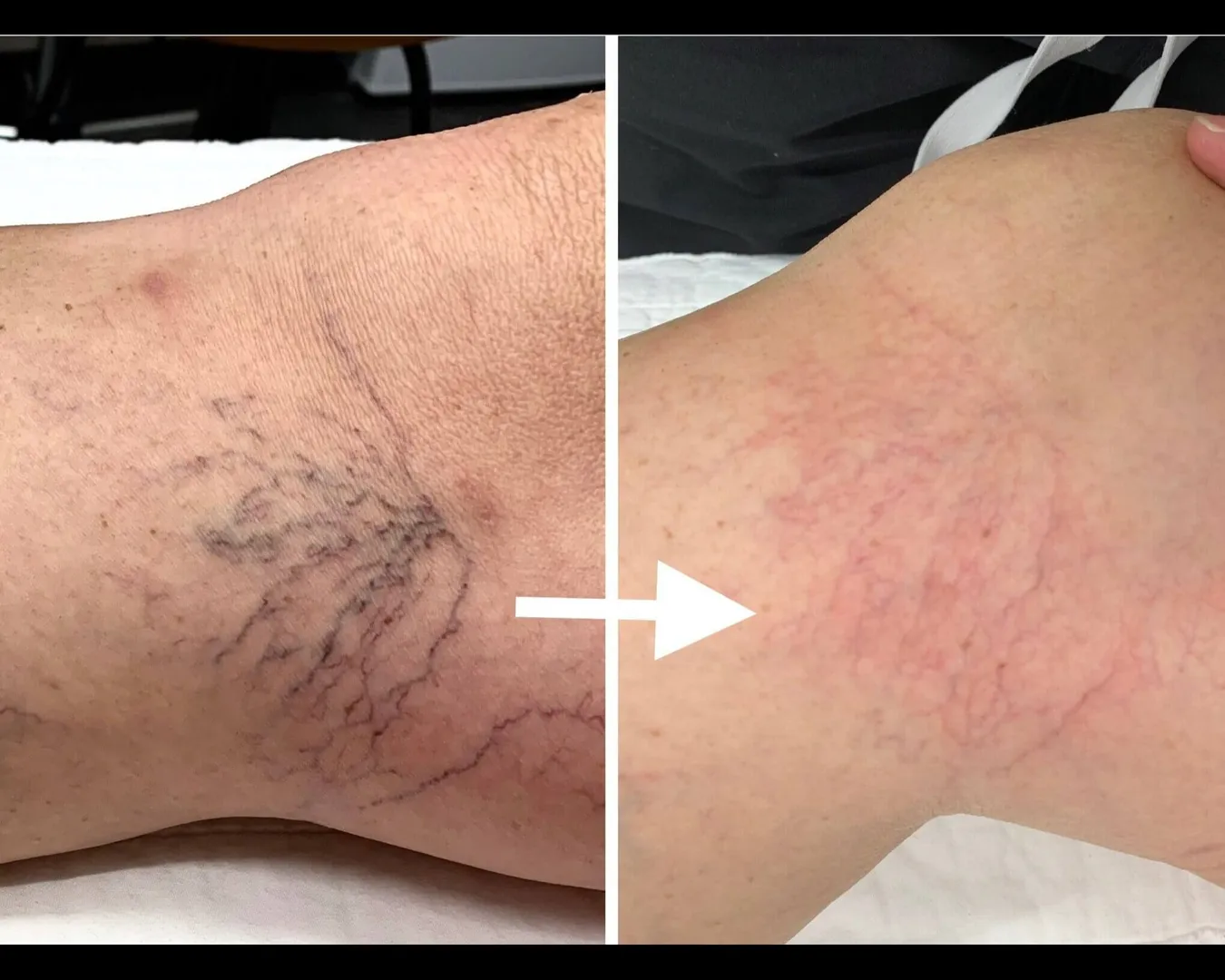 MICROSCLEROTHERAPY
✨ Say Goodbye to Spider Veins with Microsclerotherapy! ✨
Bothered by visible thr...