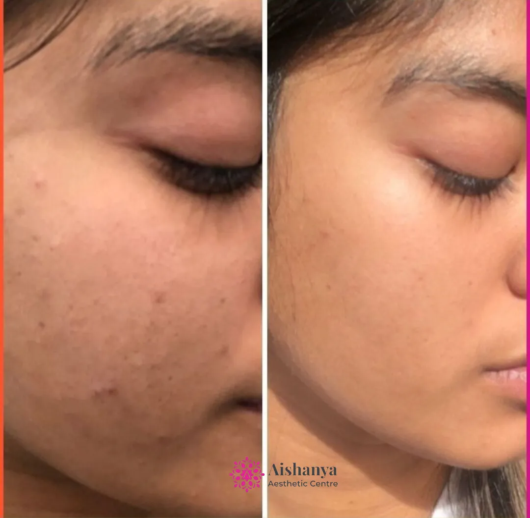 Permanent Skin Lightening Clinic in Delhi-NCR, Janakpuri, Dwarka @Aishanya Aesthetic Cen...