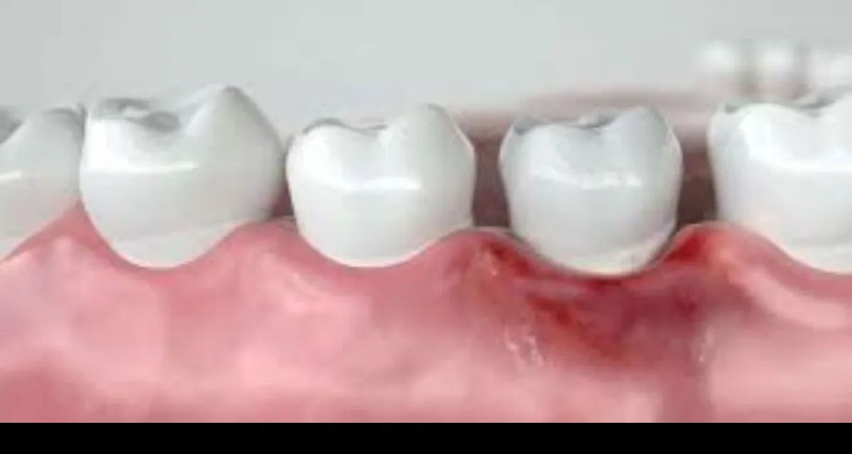 Gum Treatment in Greater Noida West – P.D. Dental Cli...