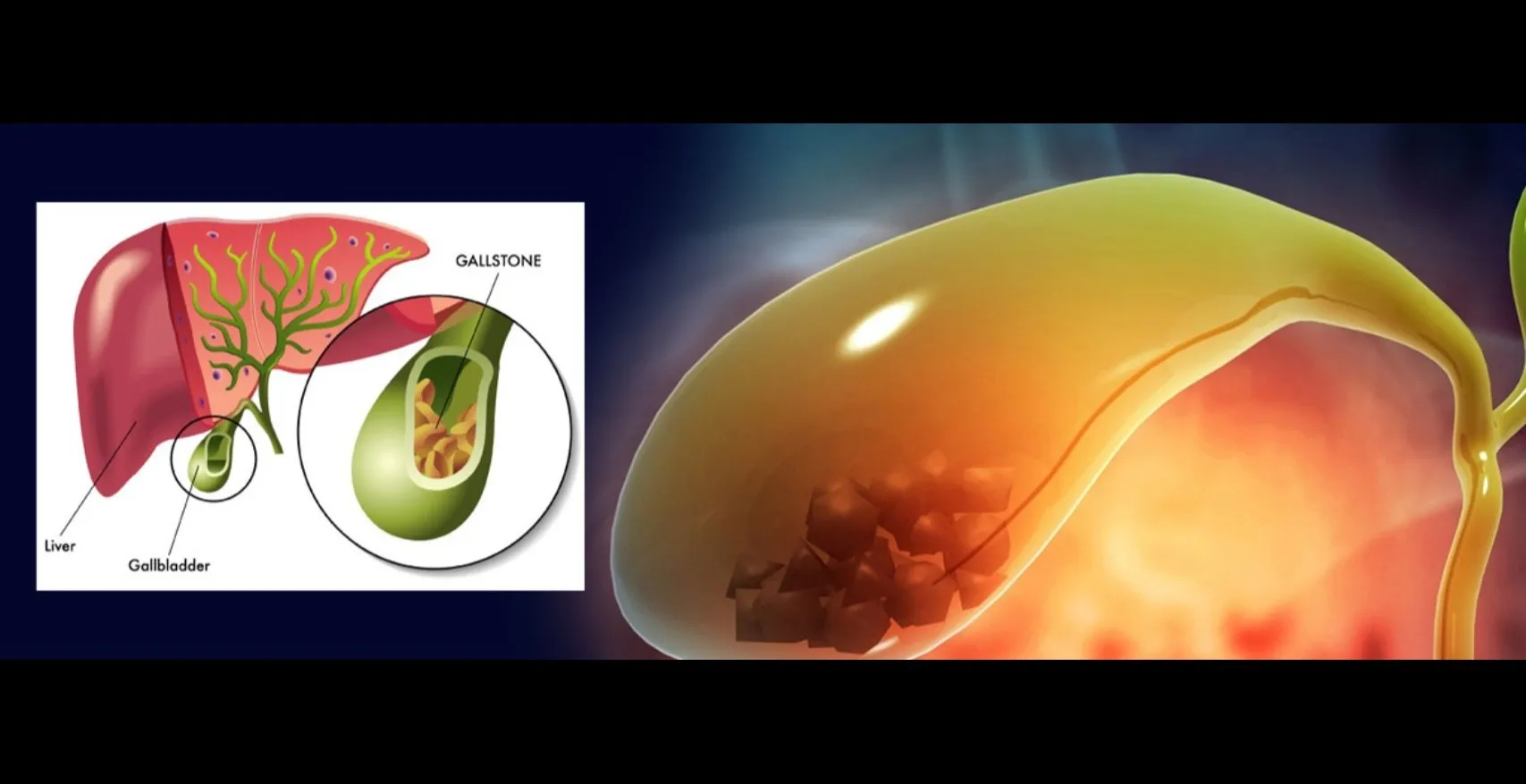 Gallbladder Removal Expert in Byculla – Safe Surgery with Quick Recov...