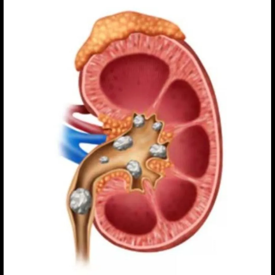 Minimally Invasive Kidney Stone Treatment in Thane – Quick Recovery, Less P...