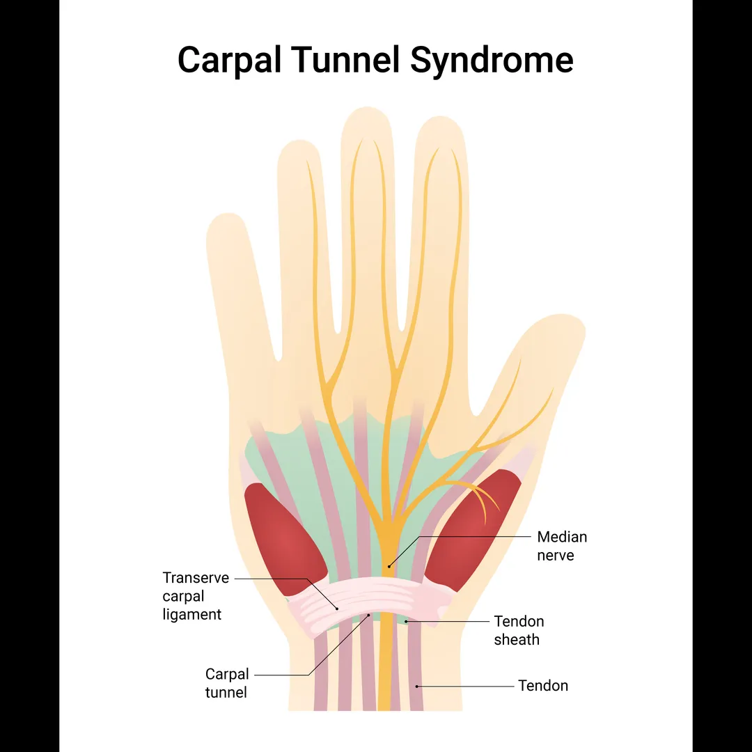 Carpal Tunnel Release Surgery in Bangalore – Relief from Numbness and Tingl...