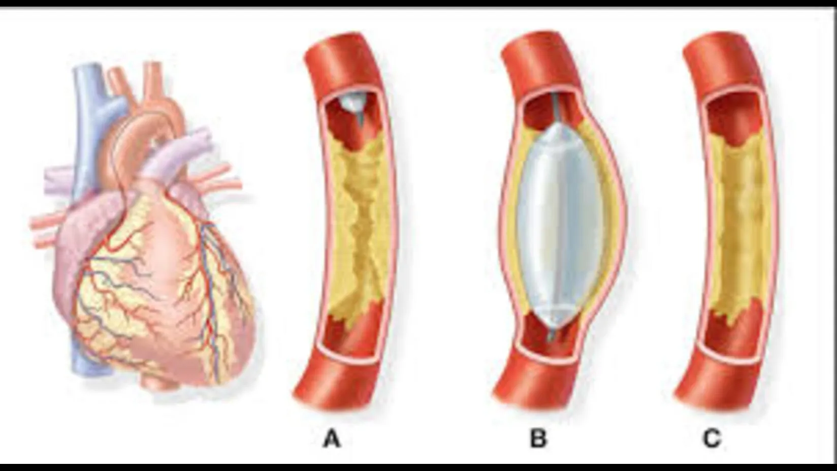 Angiography in Pune – Accurate Heart Diagnostics with Imaging Precis...