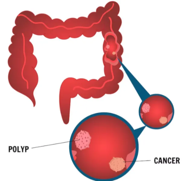 Colon Cancer Screening in Mumbai