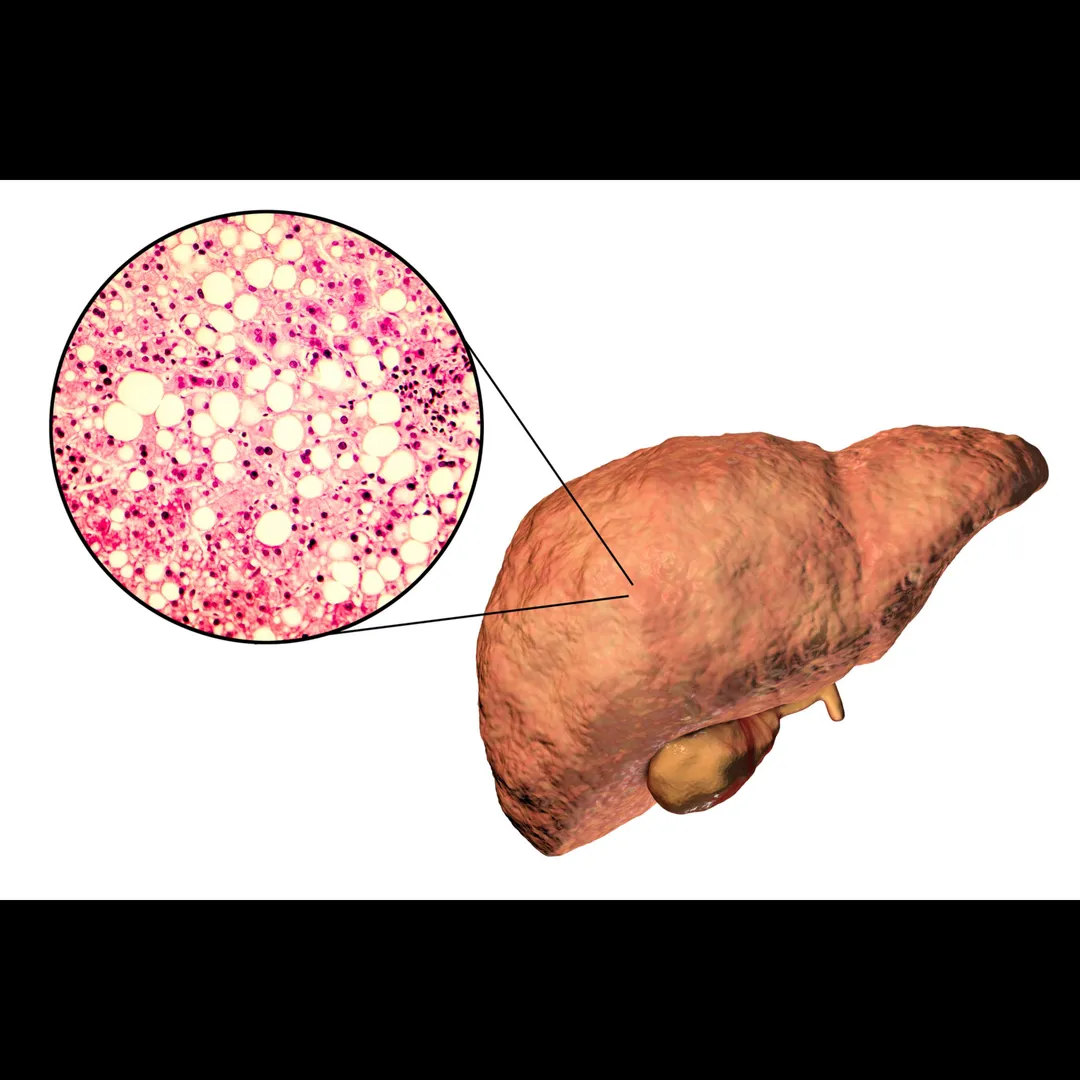 Road Safety and Hepatic Encephalopathy – A Silent Risk in Mum...