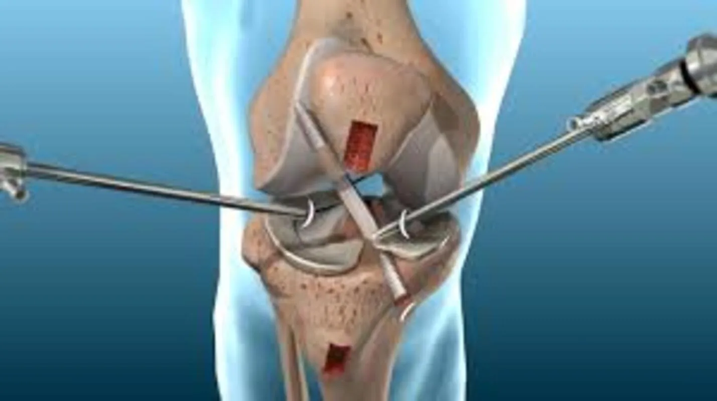 Ligament Reconstruction Surgery in Delhi – Rebuild Strength and Prevent Instabil...