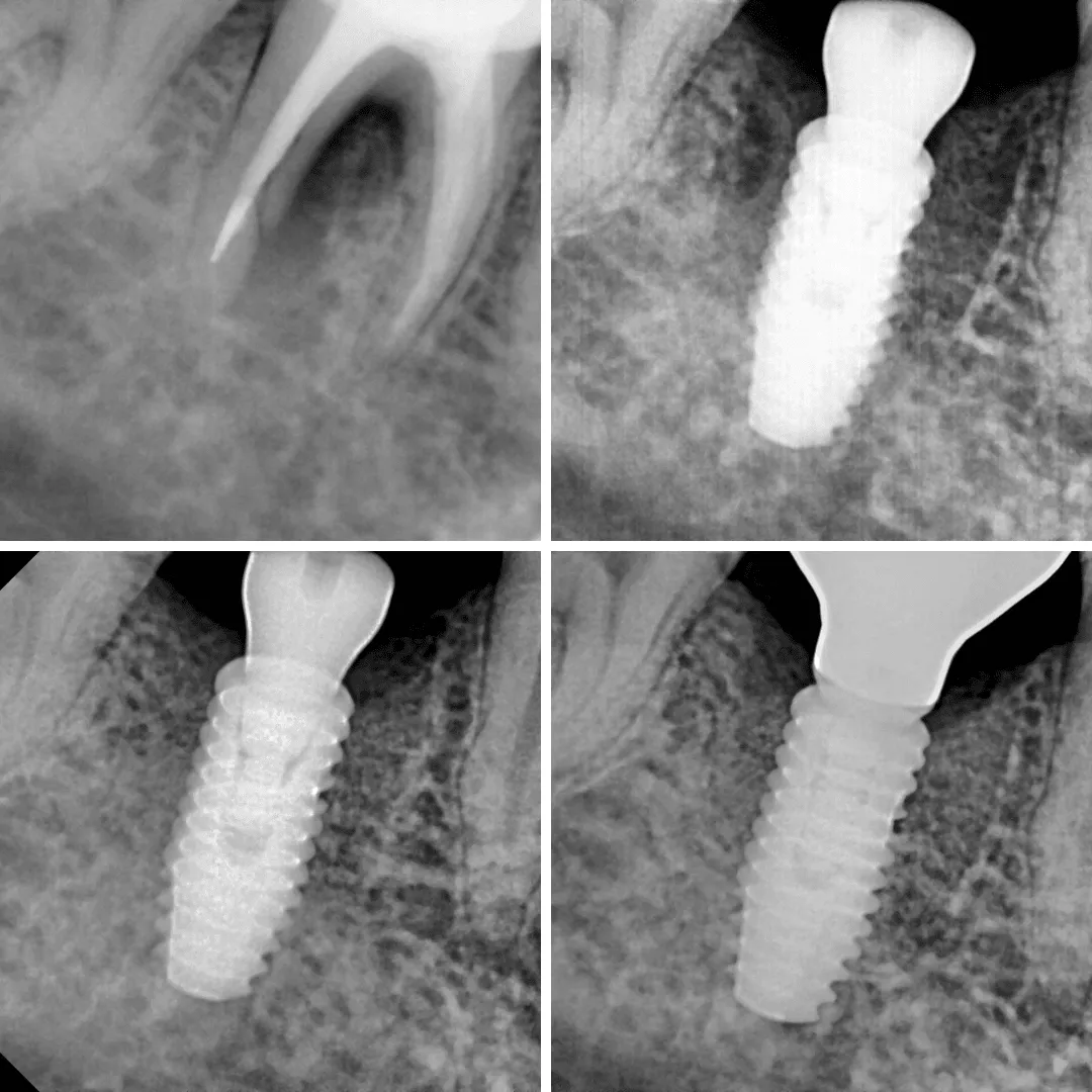 From Root Canal Failure to Full Functional Restoration with Dental Impla...