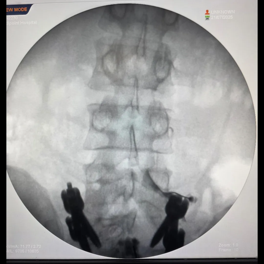 Still in Pain After Spine Surgery? Here's What You Need to Know
If you're still suffering from back ...